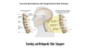 Cervical Spondylosis Comprehensive Neck Treatment