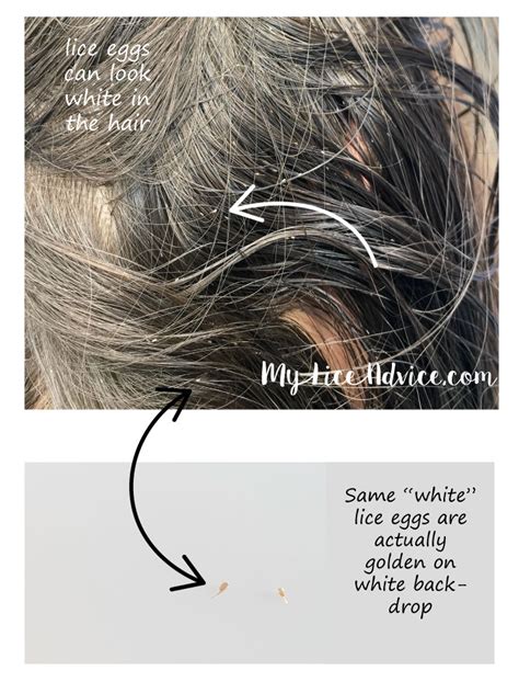 Pictures Of What Lice Eggs Nits Look Like In Hair 9 Tips To Spot Them
