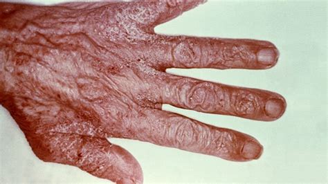 Scabies Causes Symptoms Pictures Of Rash And Treatment Everyday