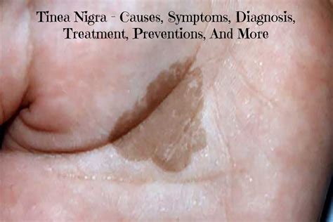 Tinea Nigra Causes Symptoms Diagnosis Treatment And More