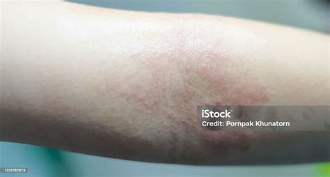 Eczema Atopic Dermatitis Symptom With Infected Skin On Child Foldable
