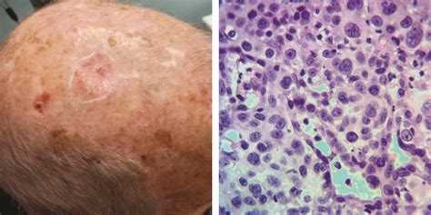 A Case Of Mistaken Identity Porocarcinoma Of The Scalp Initially