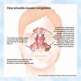 Can Gerd Cause Nasal Congestion Photos