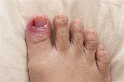 Why Do I Have Red Toes An Overview Causes And Prevention Feet