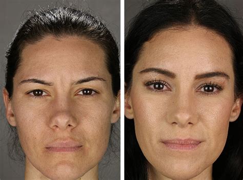 Botox Brow Lift What Is It And How Does It Work An Ultimate Guide