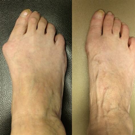 Before And After Photos Akron Podiatrist Dr Nicholas Campitelli