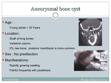Image Result For Aneurysmal Bone Cyst In The Jaws Oral Pathology Jaw