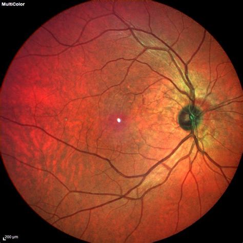 Focal Choroidal Excavation Associated Choroidal Nv In Patient With As