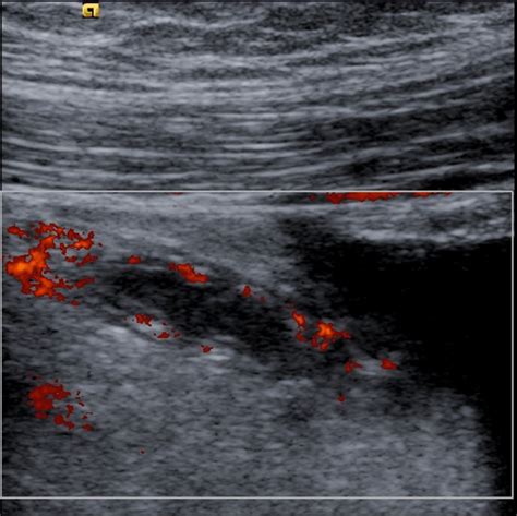 Ultrasound Of The Abdomen Shows An Inflamed Appendix Appendicitis My