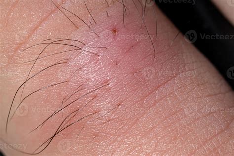 Inflammation Caused By Ingrown Hair 3796903 Stock Photo At Vecteezy