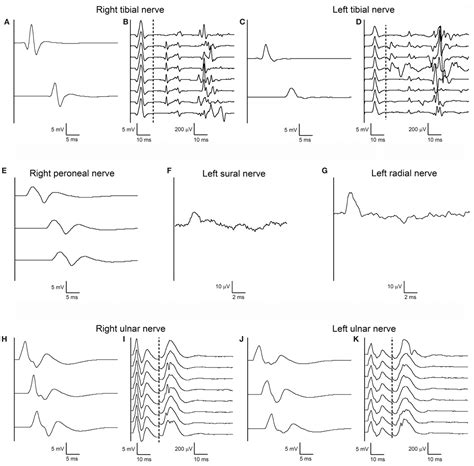 Frontiers Atypical Electrophysiological Findings In A Patient With