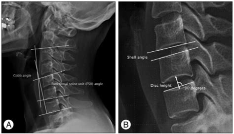 Measurement Of Static Angles On Plain Cervical Lateral Open I