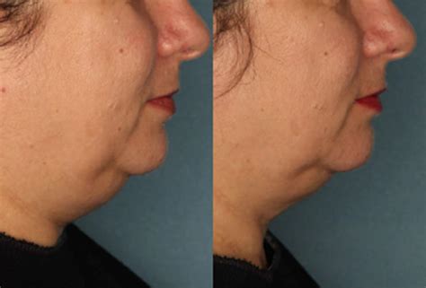 Before And After Velashape London Clinic