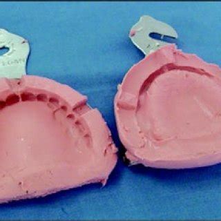 The copy denture technique is a misnomer for the clinical and laboratory procedures involved in making complete dentures that replicate most of the features of the original prosthesis. (PDF) Replacing Existing Dentures by Copy-Denture ...