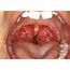 Inflamed Tonsils  Pictures Causes Symptoms Treatment