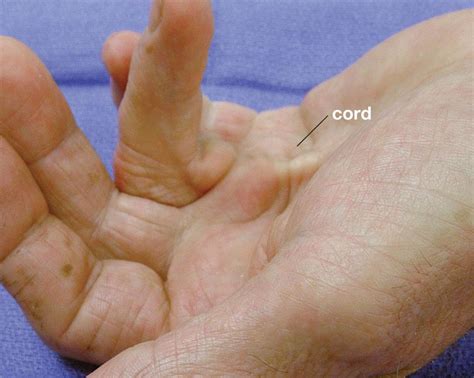 Faqs About Dupuytrens Disease And Contracture Bent Fingers Renaissance School Of Medicine At