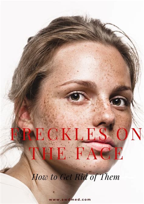 Freckles On The Face Why They Appear And How To Get Rid Of Them Freckle Remover Laser