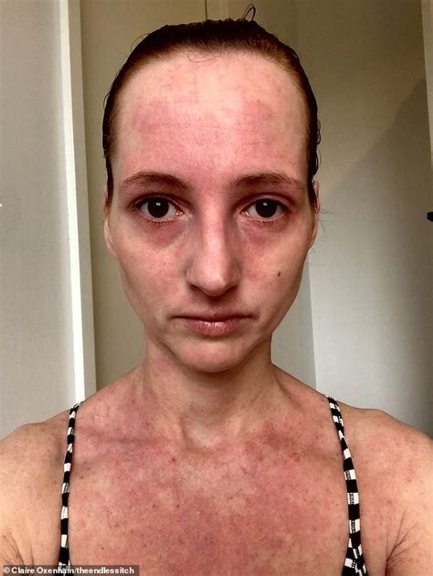 Mother Of Three Left Unable To Shower For Almost A Year Due To Eczema