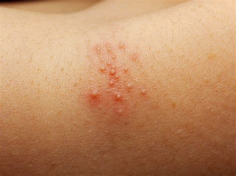 Heat Rash Prickly Heat Types Causes Symptoms Diagnosis Off The Best