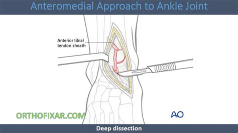 Anteromedial Approach To Ankle Joint 2023 Orthofixar