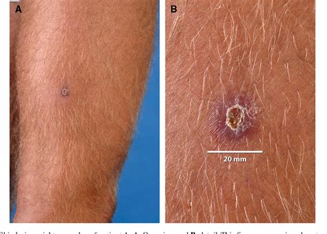 Figure From First Cases Of Cutaneous Leishmaniasis Caused By Leishmania Viannia Naiffi