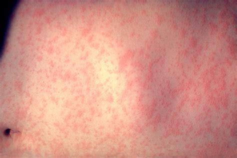 The Spread Of Measles Twin Rivers Health Care