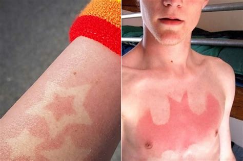Sunburn Tattoos Are The Uncool Way To Show Skin This Summer