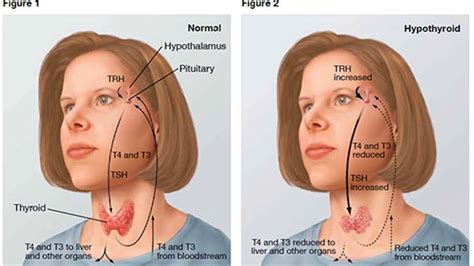 Goiter Symptoms Goiter Need Of A Doctor Youtube