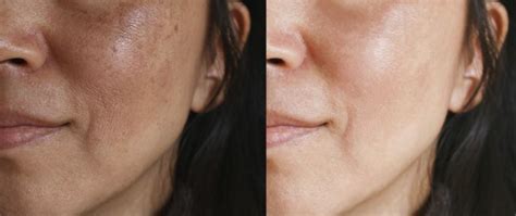 Managing Melasma Apex Dermatology Skin Care Specialists