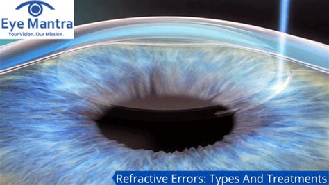 Types Of Refractive Surgery And Refractive Errors Eye Disorder