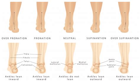 What Are Orthotics And How Do They Benefit You Neuhaus Foot And Ankle