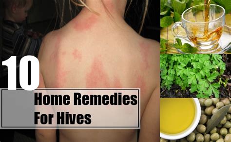 10 Home Remedies For Hives Natural Treatments And Cure For Hives