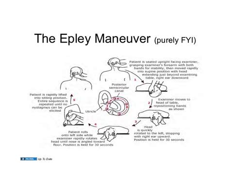 Get Epley Maneuver Instructions Spanish Images