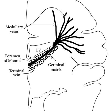 Germinal Matrix The Predilection Site For Peri Intraventricular Brain