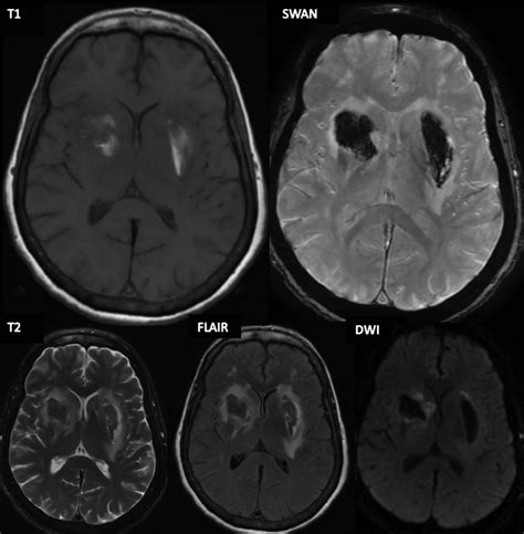 Bilateral Basal Ganglia Hemorrhage In A Patient With Confirmed Covid 19