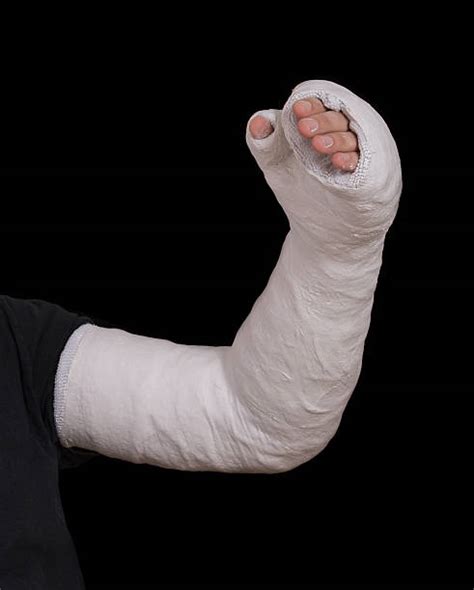 Best Arm Cast Stock Photos Pictures And Royalty Free Images Istock