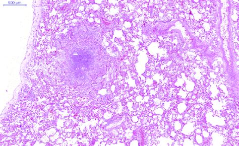 Granulomatous Inflamation And Caseous Necrosis In Lungs Case 3