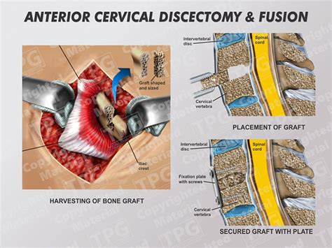 Anterior Cervical Discectomy And Fusion Rededuct Com
