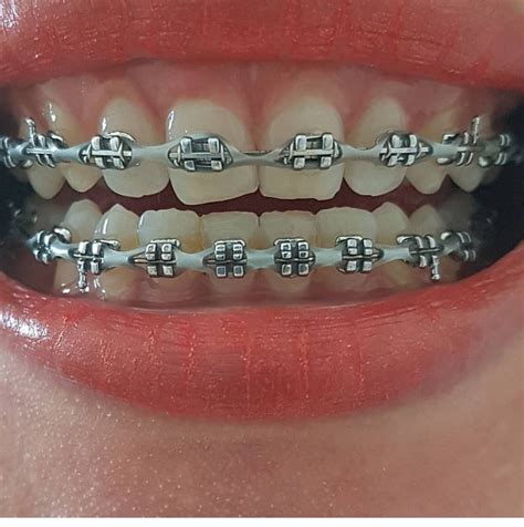 Braces Band Colors On Teeth Warehouse Of Ideas