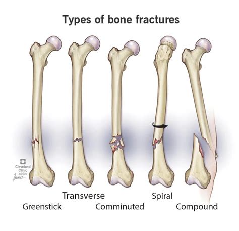 Spiral Fracture Symptoms Causes And Treatment 2023