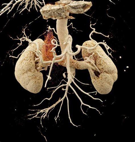 Cinematic Rendering Of The Kidneys And Pancreas And Vascular Map
