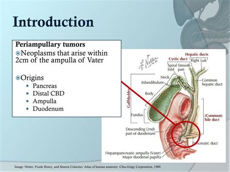 PPT Management Of Periampullary Tumor What Are The Options For