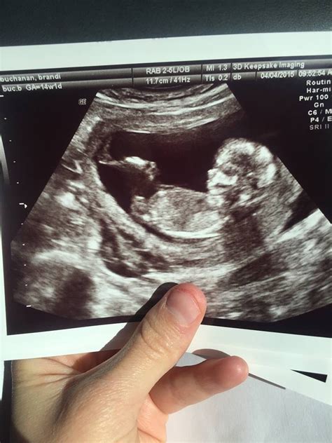 How Accurate Is My Girl Gender Prediction At 13 Weeks 5 Days Pictures