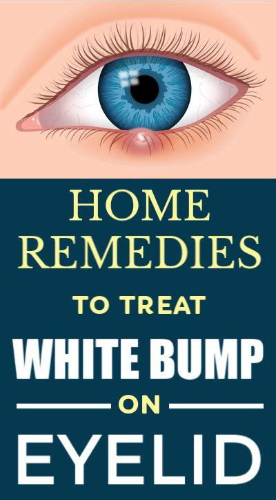 Home Remedies To Treat A White Bump On Eyelid Whitebumps Eyelids