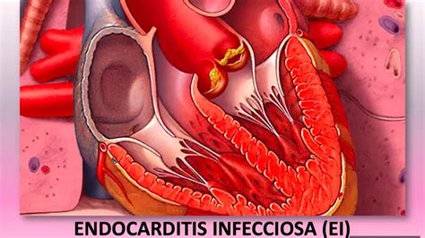 Endocarditis Infecciosa Youtube