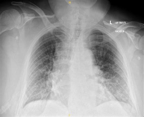 Chest X Ray Demonstrating Widespread Opacities Bilaterally More
