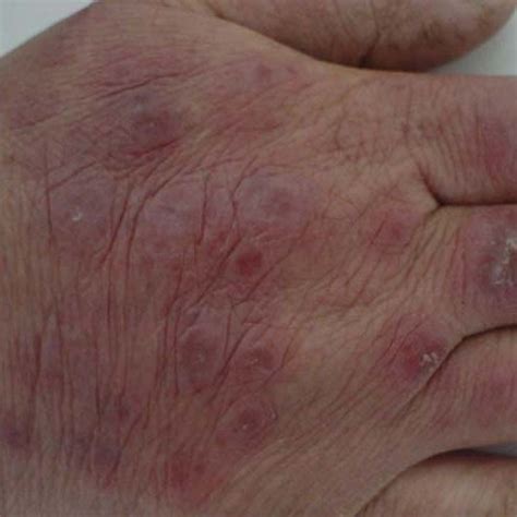 The Patient On Presentation Erythematous Targetoid Lesions On Hands