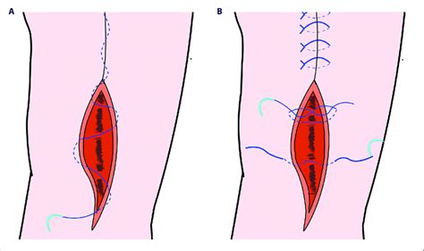 A Showed The Running Subcuticular Technique For Absorbable Suture