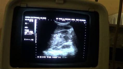 Renal Abscesses Ultrasound Youtube