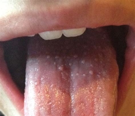 Bumps On Back Of Tongue Sore Throat